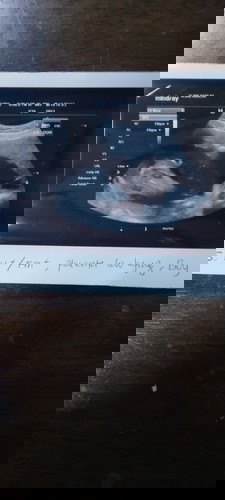Scan gender baby