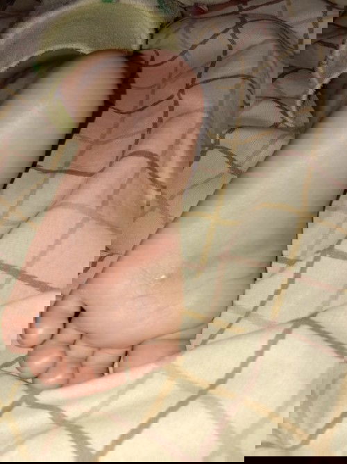 Garis merah di telapak kaki