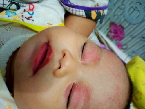 mata anak merah di kelopak mata