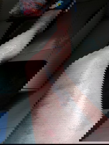 Rashes during pregnancy