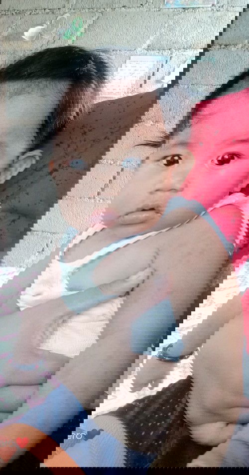 Rashes sa kamay ni baby