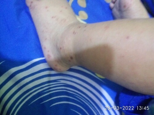 Bun mau tnya salep apa ya buat ngilangin bekas gatel kulit si Ade jadi item2 gitu? Mhn bntuannya bun