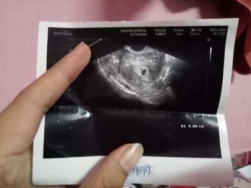 ภาวะแท้งคุกคาม