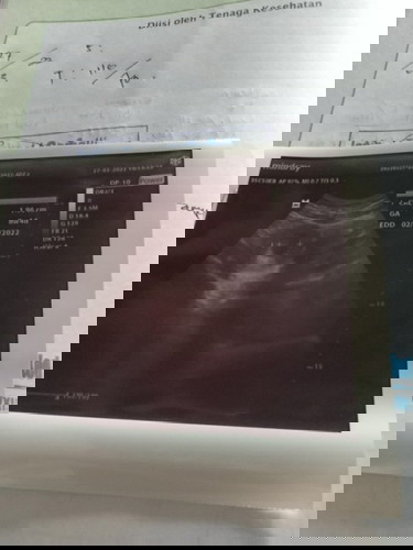 Disini ada yng pernah USG di usia kehamilan 8minggu lebih tapi blum ada janin nya gak Bun?