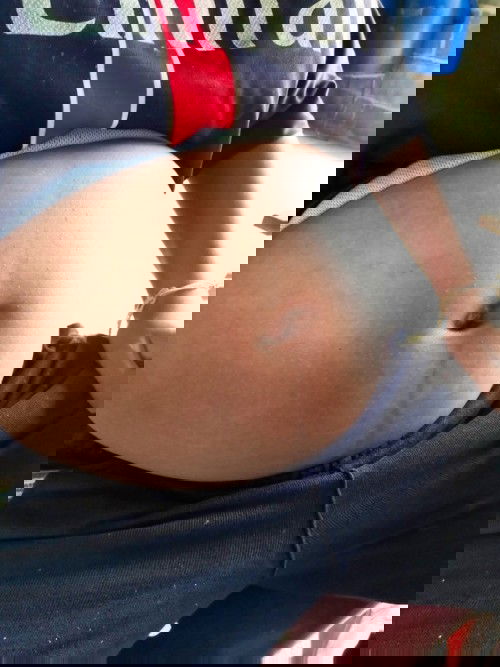 ท้องมีตุ่มเล็กๆขึ้นมา