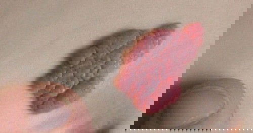 ขอคำแนะนำแม่ๆ หน่อยค่ะ น้องมีปานสตรอเบอร์รี่ มีวิธีรักษาอย่างไรบ้างคะ