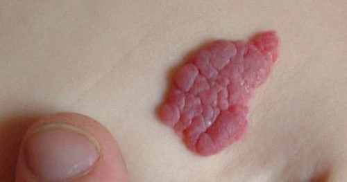 ขอคำแนะนำแม่ๆ หน่อยค่ะ น้องมีปานสตรอเบอร์รี่ มีวิธีรักษาอย่างไรบ้างคะ