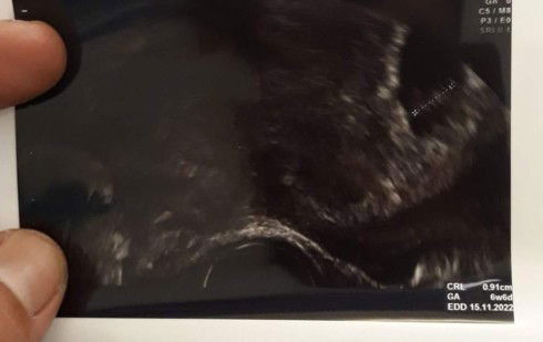 6weeks 6 days with history of fibroid removal.