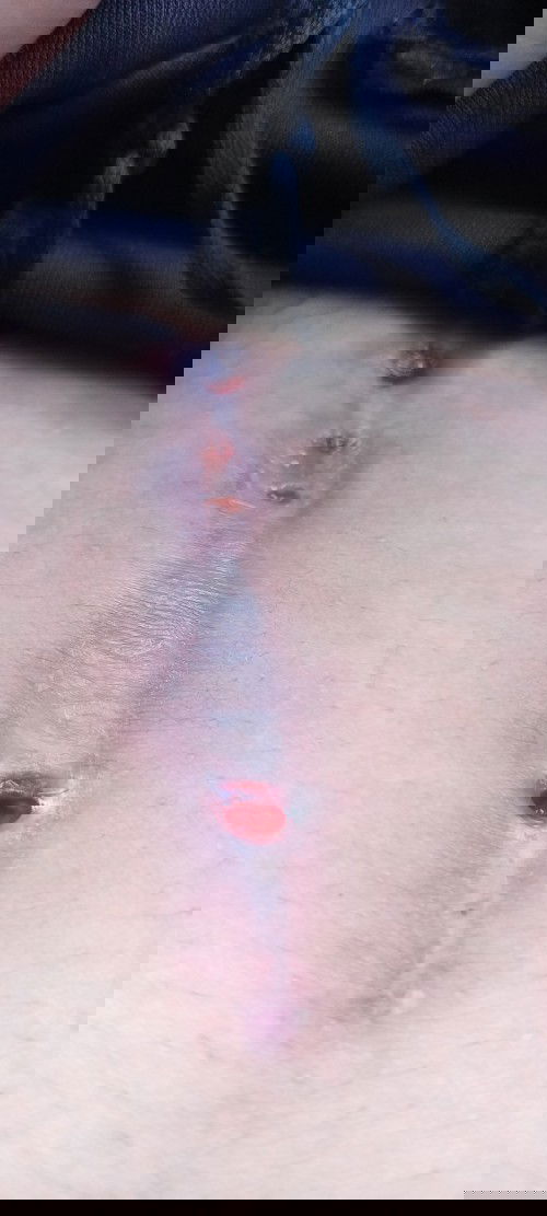 Nabutas at nagtutubig ang tahi..