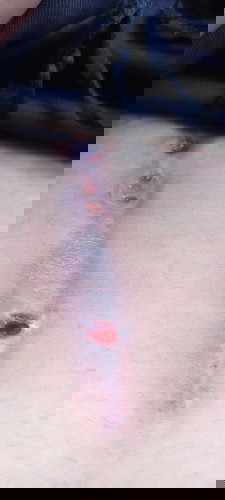 Nabutas at nagtutubig ang tahi..