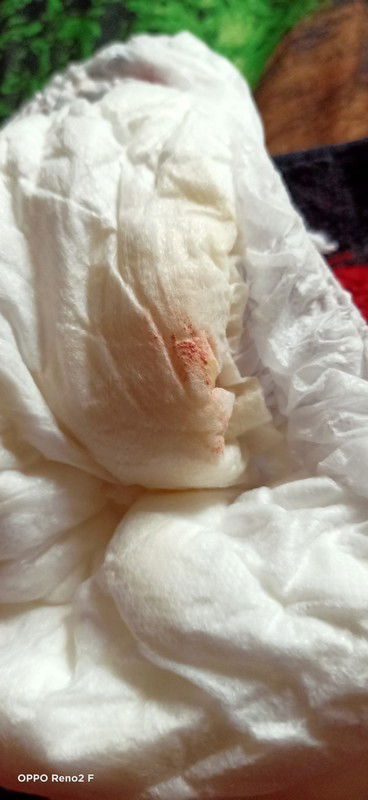 Keluar lendir orange di kemaluan Bayi 5bulan