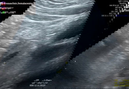 Usg pertama dan kedua berbeda Usia Kandungan