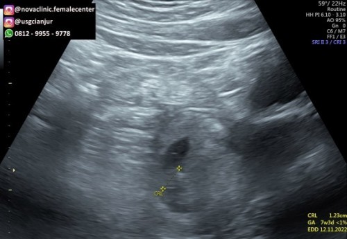 Usg pertama dan kedua berbeda Usia Kandungan