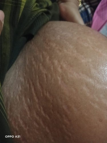 Pake Vas*lin* tetap muncul Stretchmark