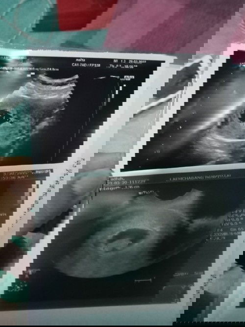 ลูกหัวใจไม่เต้น