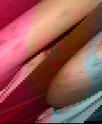 Cacar air / kutu air