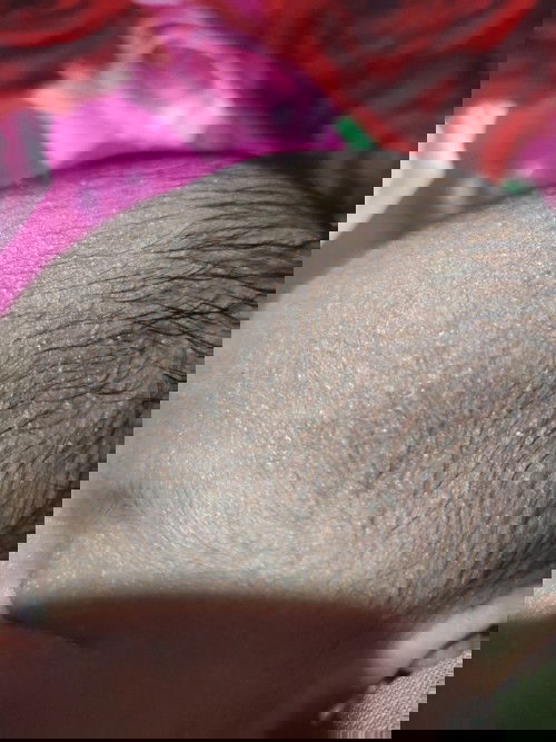 Kepala bayi beruntusan