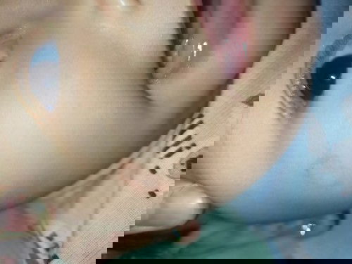 Bercak diwajah anak ku