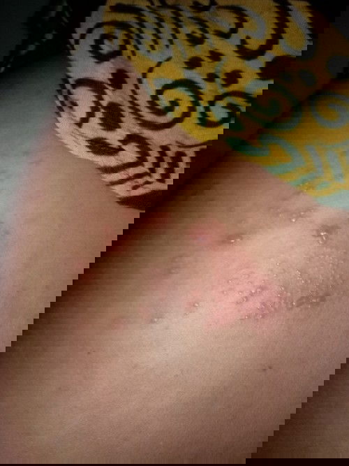 Bentol gelembung air