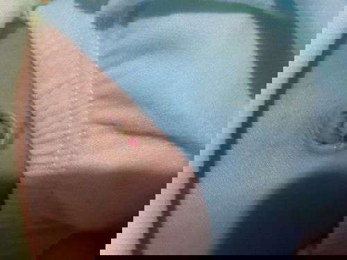 Tali pusar berdarah setelah puput