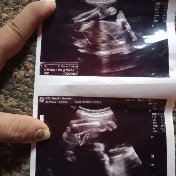 Beby twins msuk 33wek