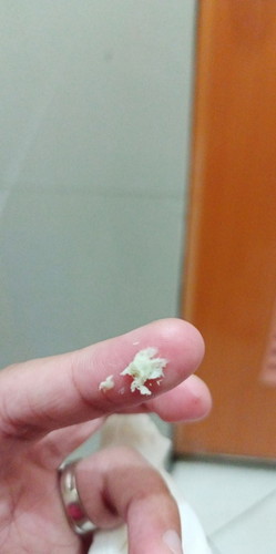 Vaginal Discharge