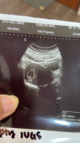 scan baby 6week masih taknampak