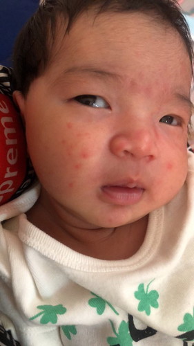 ลูกผื่นขึ้นหน้า ใช้อะไรดี