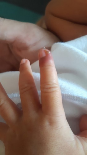 Jari bayi seperti terkelupas