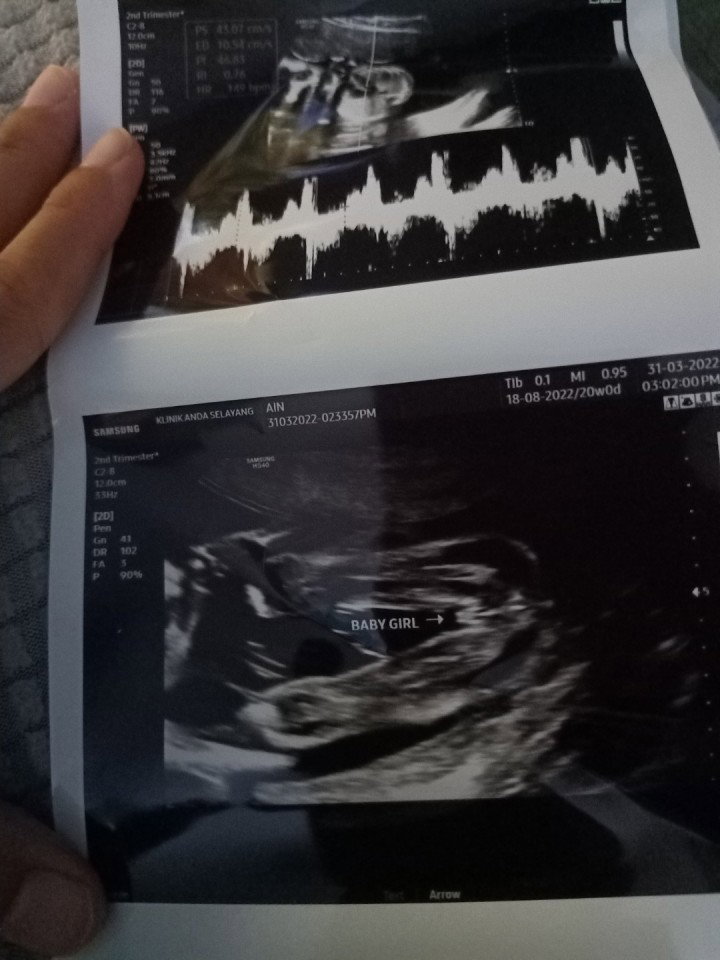20 minggu buat details scan alhamdulillah dapat baby girl. Semoga membesar dengan sihat dan sempurna
