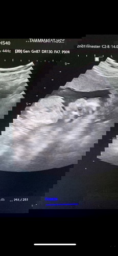 ขอดูภาพอัลตร้าซาวด์ 17 week หน่อยจ้า