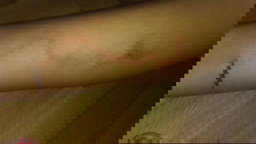 kulit melepuh gatal bergaris seperti ular