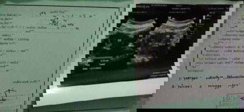 Bunda, mau tanya. Disini ada yg umur janin 7 minggu tapi waktu usg masih terlihat kantong saja?