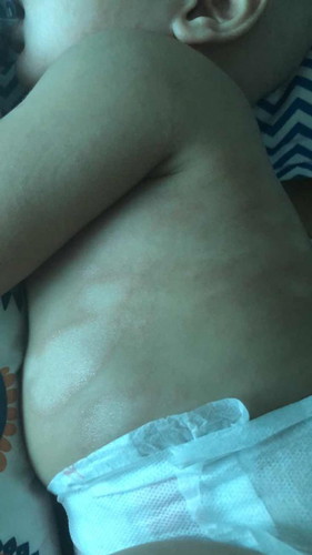 kulit baby 5bulan kering, ada ringworm. Tolong saya runsing π₯Ί