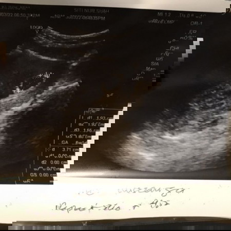 Missed Miscarriage. Ibu2 ada tak pengalaman macam sy ? 😖