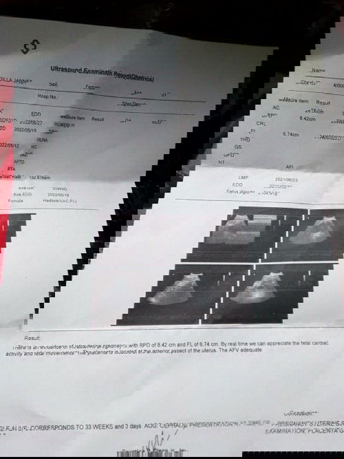 Anterior Placenta grade 3 ?