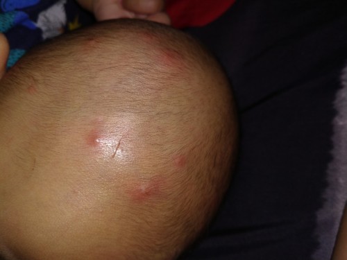 Bintik merah seperti jerawat