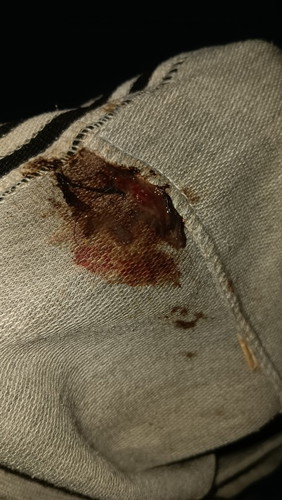 39+5วีค ตรวจภายในกระตุ้นปากมดลูก