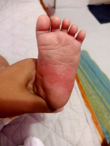 Skin problem