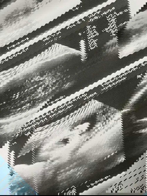 ขับมอเตอร์ไซค์ล้มตอนท้องอ่อนๆ กระดูกไหปลาร้าหัก ต้องผ่าตัด