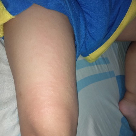 rashes on toddlers