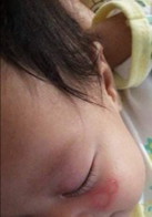 Is it ATOPIC DERMATITIS (Eczema) ?