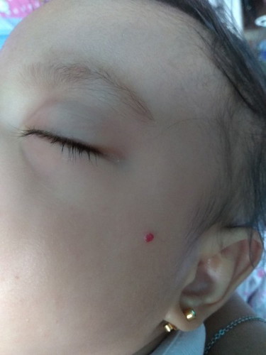 mga mommy ask ko lang po kung nunal ba or ano tong red sa mukha ng baby ko , nung 6 months lang yang