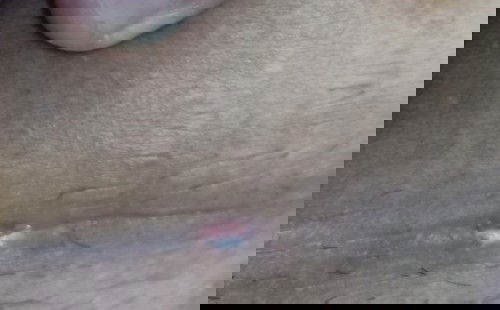 Luka sc terbuka setelah 1 bulan