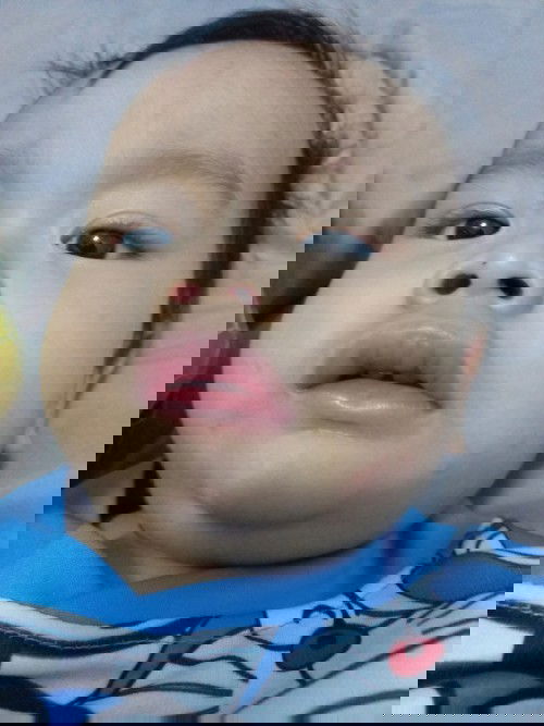 ตื่นมาปากลูกบวม