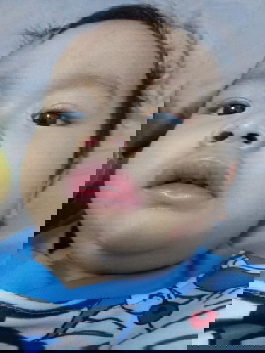 ตื่นมาปากลูกบวม