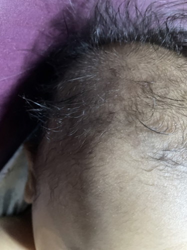 Sa ulo ni baby parang may guhit sa skull nya na at the same time my litid..nagwoworry po ako..first time mom..