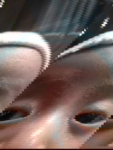 Cho mình hỏi ở gần lông mày làm sao hết vẩy trắng này ah.