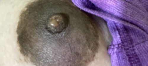 Hello, ask ko lang po if ano tong nasa nipple ko. Flat or inverted