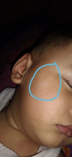 bercak putih diwajah bayi